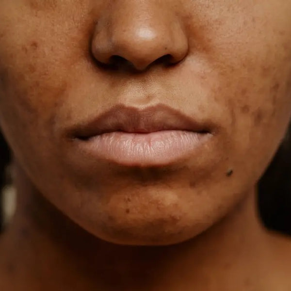 Vous voulez tout s'avoir sur l'hyperpigmentation ?