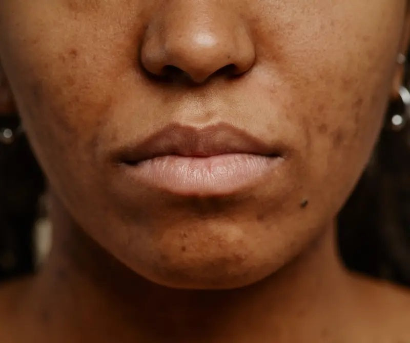 Vous voulez tout s'avoir sur l'hyperpigmentation ?