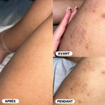 Anti-blemish Body Pack